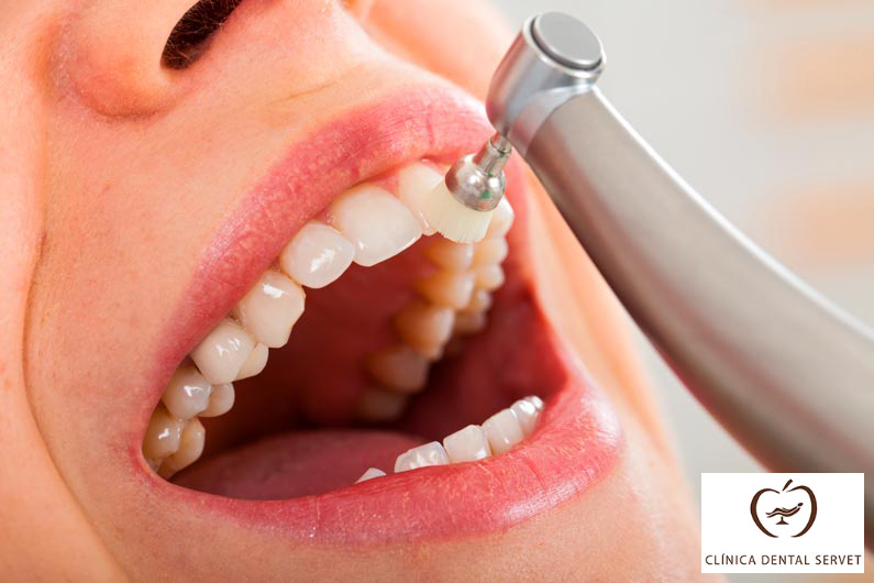 ¿Cada cuánto se debe hacer una limpieza dental?